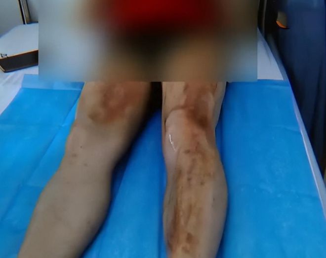 必威冷水壶烫伤老人家属索赔10000元厂家：我让你往里放烫水的(图2)